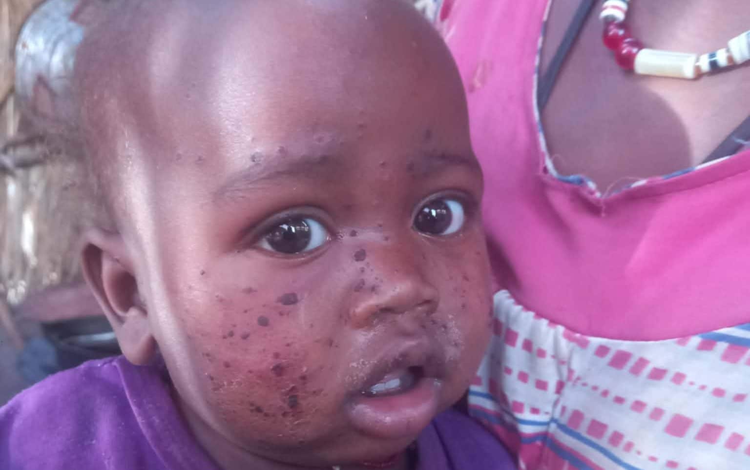 Suspected mpox outbreak with hundreds of cases hits Sudan’s Darfur